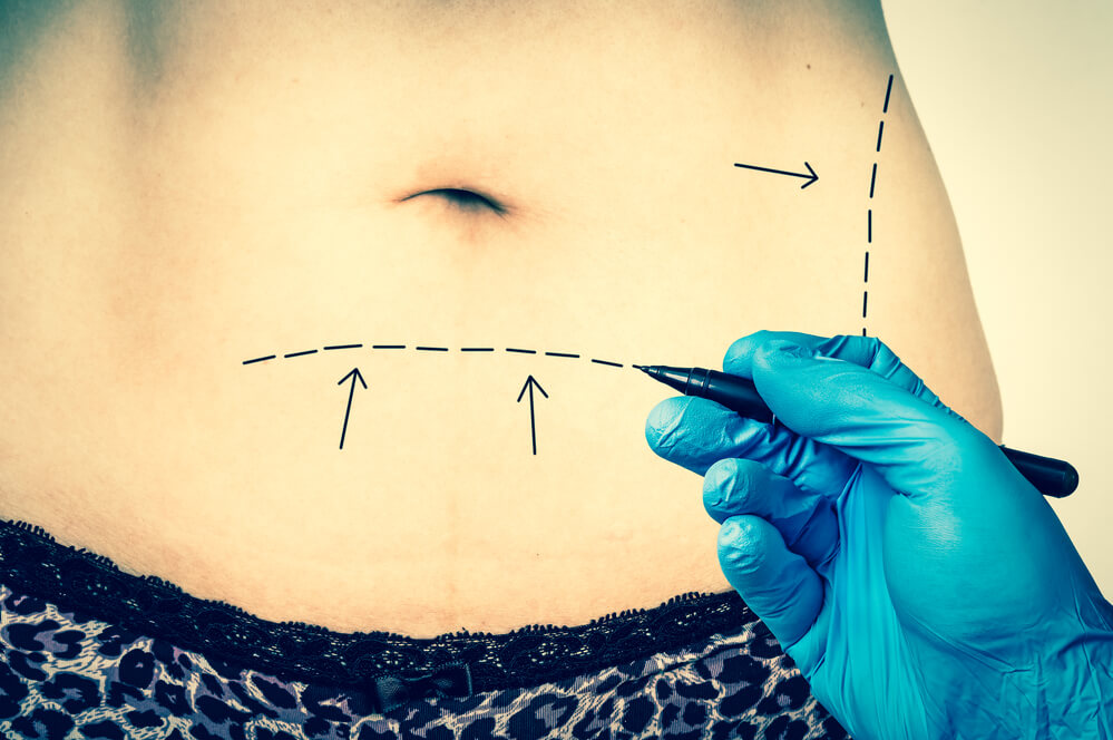 רופא כירורגיה פלסטית מצייר קווים על בטן המטופל